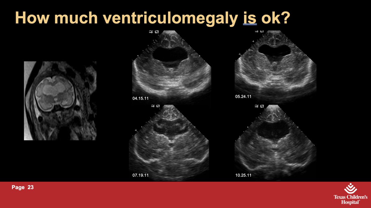 American Society of Pediatric Neuroradiology (@the_aspnr) on Twitter photo IPNTN: <a href="/ThierryHuisman/">Thierry A.G.M. Huisman, MD, PD, FICIS, FACR</a> from <a href="/TCHRadiology/">Texas Children's Radiology</a> dives into the deep waters of the ventricles. Incidental ventricular asymmetry could be an isolated finding, but important to scrutinize for subtle malformations on fetal MRI. And how much ventriculomegaly is okay? Is it just the tip of IPNTN: <a href="/ThierryHuisman/">Thierry A.G.M. Huisman, MD, PD, FICIS, FACR</a> from <a href="/TCHRadiology/">Texas Children's Radiology</a> dives into the deep waters of the ventricles. Incidental ventricular asymmetry could be an isolated finding, but important to scrutinize for subtle malformations on fetal MRI. And how much ventriculomegaly is okay? Is it just the tip of