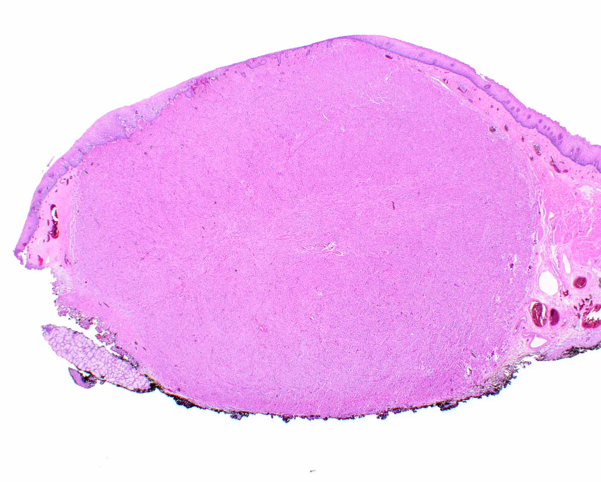ModernPathology's tweet image. There are so many wonderful vintage articles in Modern Pathology, including this classic on granular cell tumor.  Note the pseudoepitheliomatous hyperplasia associated with this esophageal granular cell tumor.
Filie AC, Lage JM, Azumi N. Immunoreactivity of S100 protein,…