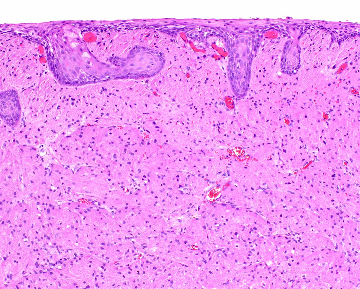 ModernPathology's tweet image. There are so many wonderful vintage articles in Modern Pathology, including this classic on granular cell tumor.  Note the pseudoepitheliomatous hyperplasia associated with this esophageal granular cell tumor.
Filie AC, Lage JM, Azumi N. Immunoreactivity of S100 protein,…