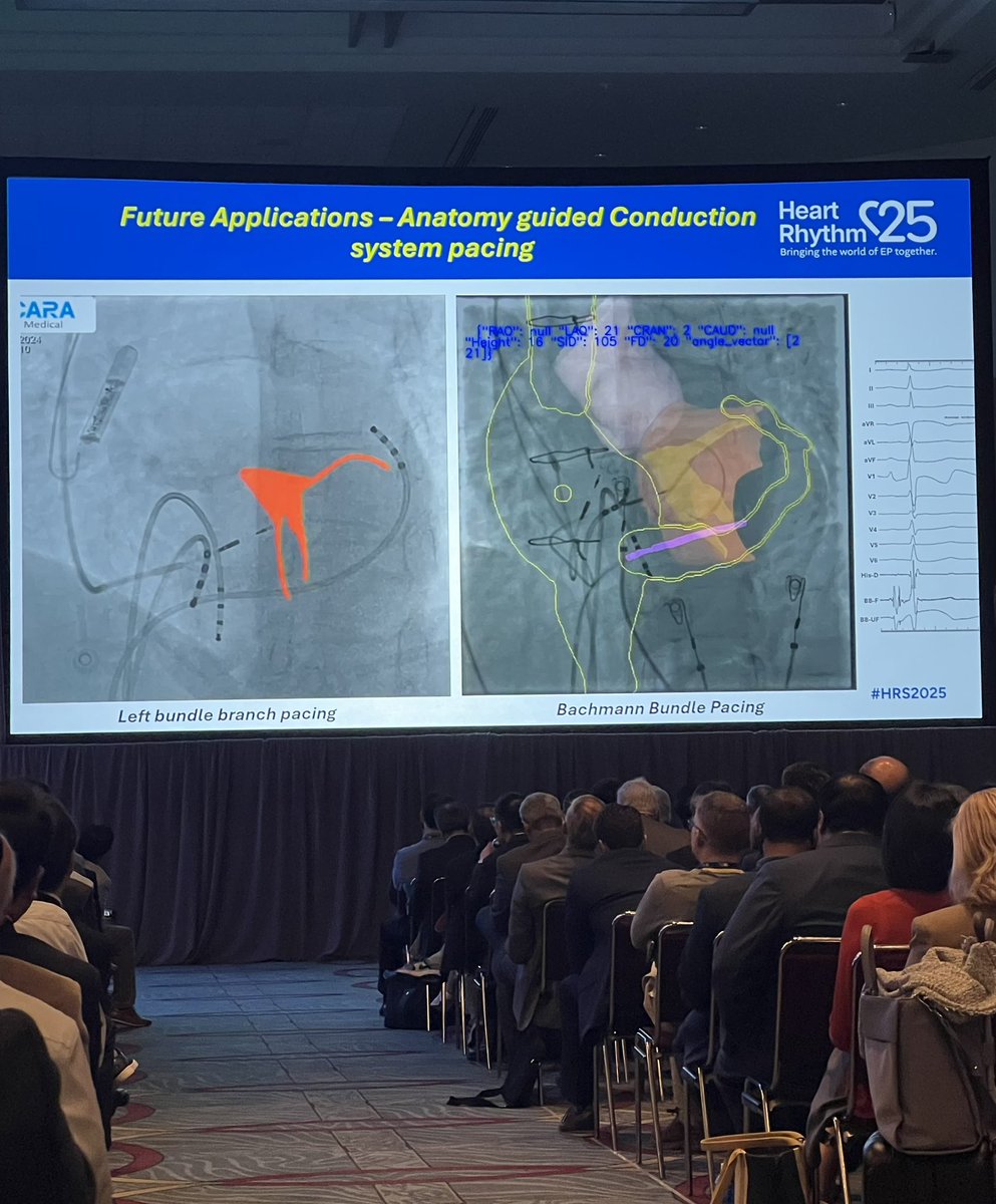 Fatima Ezzeddine (@ezzeddinemd) on Twitter photo The future of CSP with anatomy-guided CSP
There were better clinical outcomes with:
✔️ closer lead tip position to the HB
✔️ closer lead tip position to the LV endocardium
<a href="/shunmug_his_mdu/">Shunmuga Sundaram Ponnusamy</a> The future of CSP with anatomy-guided CSP
There were better clinical outcomes with:
✔️ closer lead tip position to the HB
✔️ closer lead tip position to the LV endocardium
<a href="/shunmug_his_mdu/">Shunmuga Sundaram Ponnusamy</a>