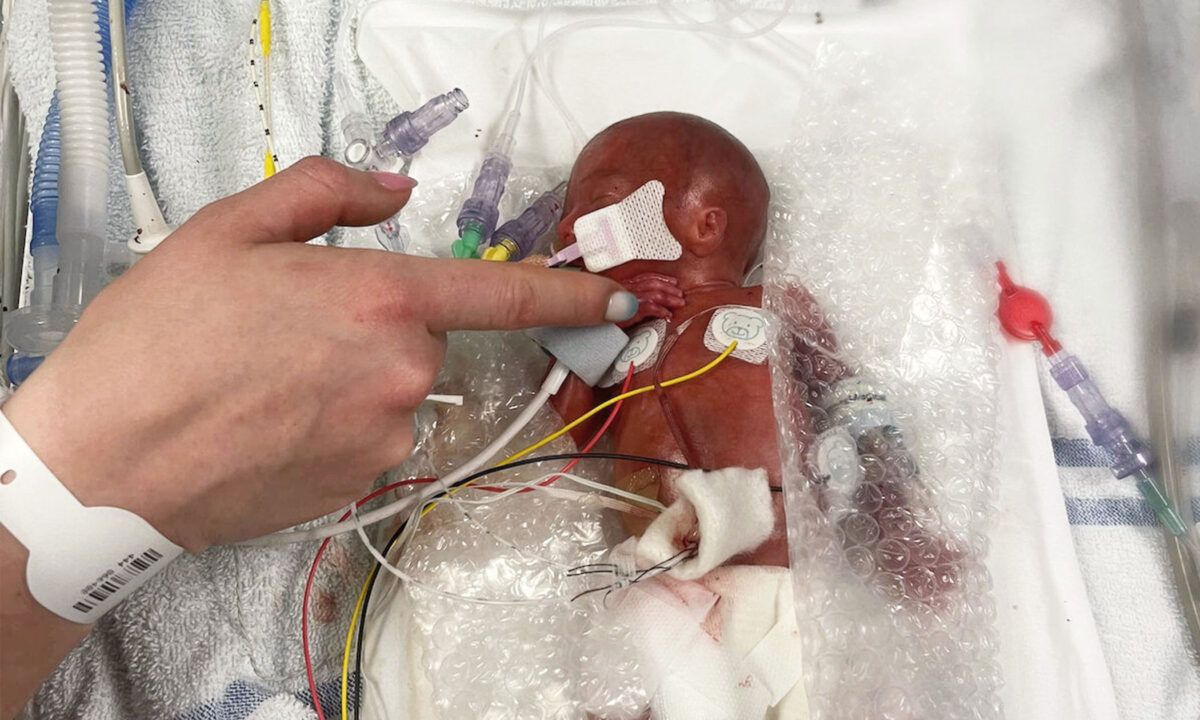 LifeNewsHQ's tweet image. This is Baby Isla.

She was born prematurely at 22 weeks.

She's not a clump of cells, or a parasite, or just a "fetus."

She is a human being with a right to LIVE.

buff.ly/WrH4JfE