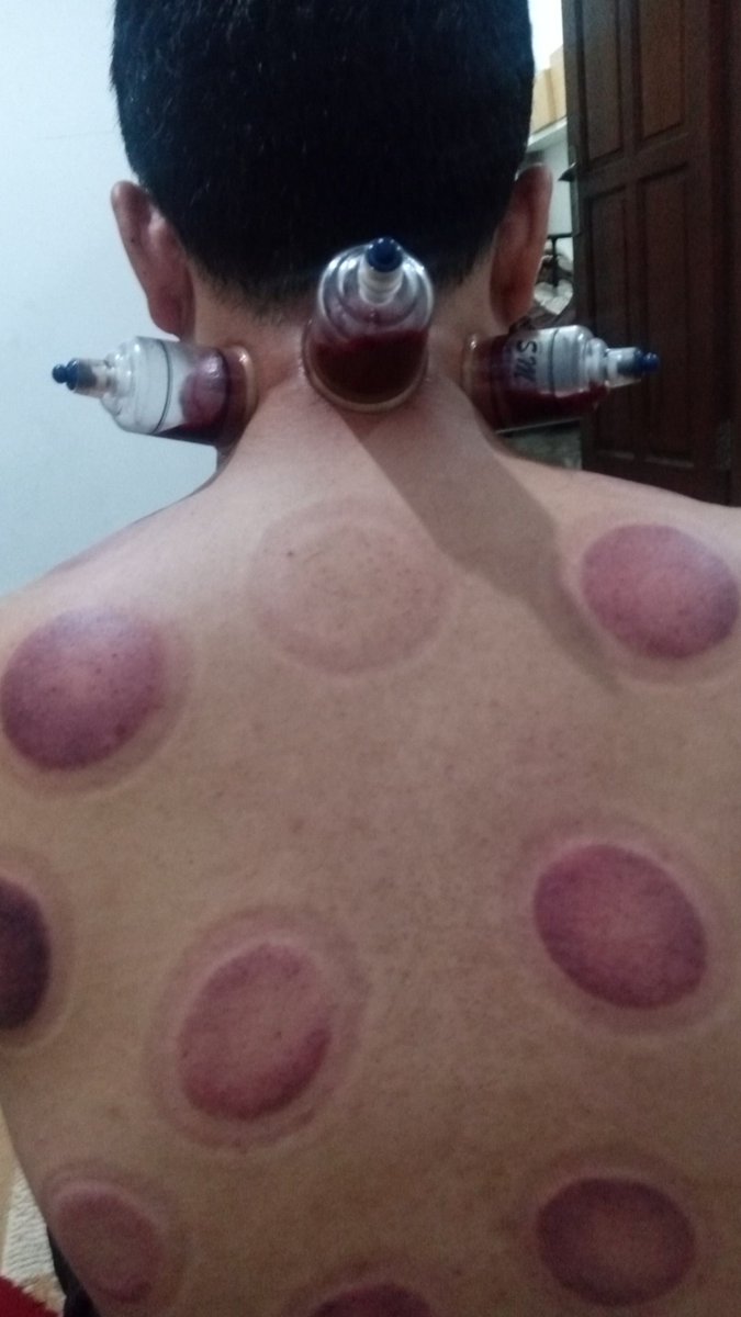 MbuyPijit's tweet photo. Asalamualaikum
Yuu jadwalin hari n waktu y..
Pijit panggilan area bogor
-pijit full body massage
-Reflexy
-totok wajah
-kop angin
-kerokan
-bekam
-call 089605467846 txz https://t.co/QcWPIj8f9q