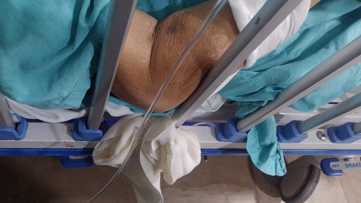 pumadesdelacuna's tweet photo. @JosAnto18374786 @Tu_IMSS @zoerobledo @SinEmbargoMX pido trato humano a mi familiar, anoche 11pm lo trasladaron de MagadalenSalinas a HospitaldeZona29 donde no hay médicos ni camas suficientes, lo tienen en camilla, sábanas sucias, no usaron el catéter que habían puesto, está amarrado, gente en espera >2 dias cama @jorgegarralda https://t.co/rMiZV1z6vM