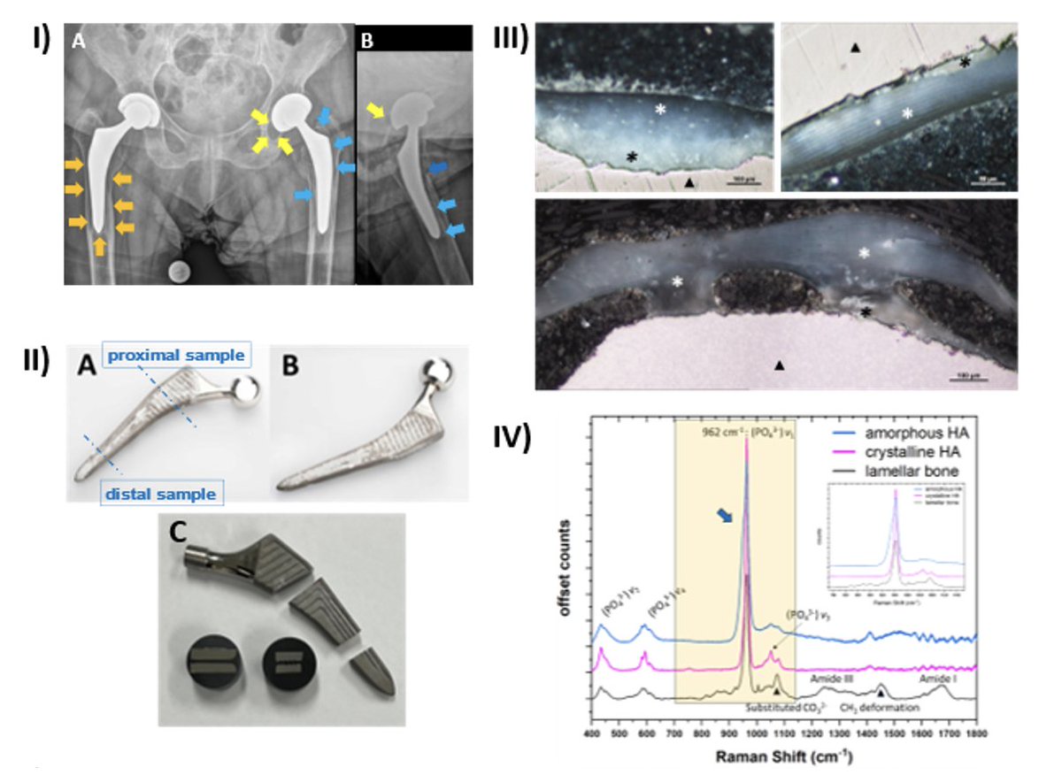 Basic Science Tips (in Memory of Fred Nelson, MD) (@orthoscienctips) on Twitter photo 🦴 Does hydroxyapatite (HA) coating help or hinder total hip arthroplasty #implants? Check out this <a href="/ORSsociety/">Orthopaedic Research Society</a> Basic Science Tip to learn how HA supports early bone attachment but may compromise long-term integration, leading to failure. Read now: ors.org/basic-science-… 🦴 Does hydroxyapatite (HA) coating help or hinder total hip arthroplasty #implants? Check out this <a href="/ORSsociety/">Orthopaedic Research Society</a> Basic Science Tip to learn how HA supports early bone attachment but may compromise long-term integration, leading to failure. Read now: ors.org/basic-science-…