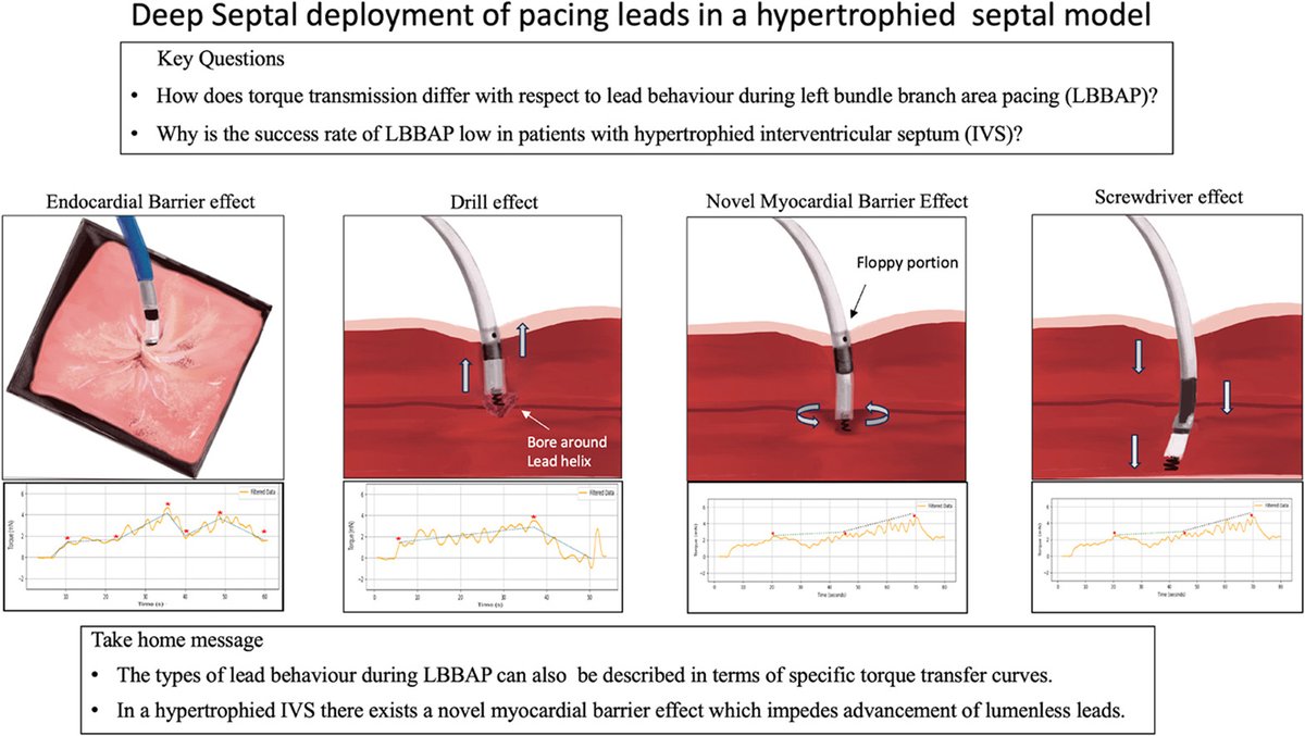 HeartRhythm (@hrs_journal) on Twitter photo Left Bundle Area Pacing In Hypertrophied Hearts: An Ex-Vivo Ovine Model To Study Deployment Of Pacing Leads In Thick Septum
#HRS2025 #OpenAccess
<a href="/PrashSanders/">Prash Sanders</a> <a href="/UniofAdelaide/">Uni of Adelaide</a>
heartrhythmjournal.com/article/S1547-… Left Bundle Area Pacing In Hypertrophied Hearts: An Ex-Vivo Ovine Model To Study Deployment Of Pacing Leads In Thick Septum
#HRS2025 #OpenAccess
<a href="/PrashSanders/">Prash Sanders</a> <a href="/UniofAdelaide/">Uni of Adelaide</a>
heartrhythmjournal.com/article/S1547-…