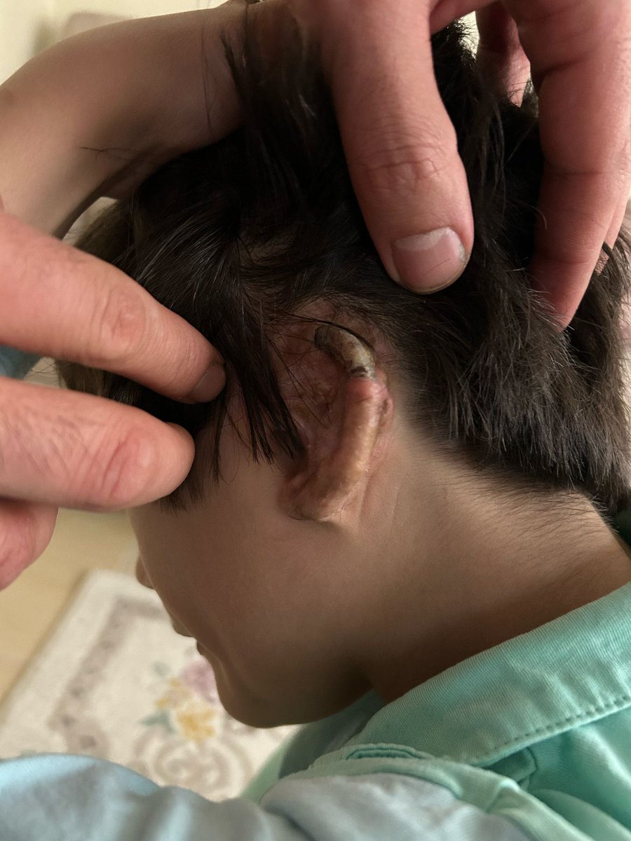 Adı : Yiğit Tuğra
2024 yılında Kulak ameliyatını yaptırdığımız Tuğra 'nin vucudu kulagina uygulanan dokuyu kabul etmedi.
Acilen yeniden kulak operasyonu yapılması gerekli 
30.000 TL ye ihtiyaçları var
 Annesi Dinçer Azaphan'ın hediye ettiği imzalı formayi satmayı düşünüyor.