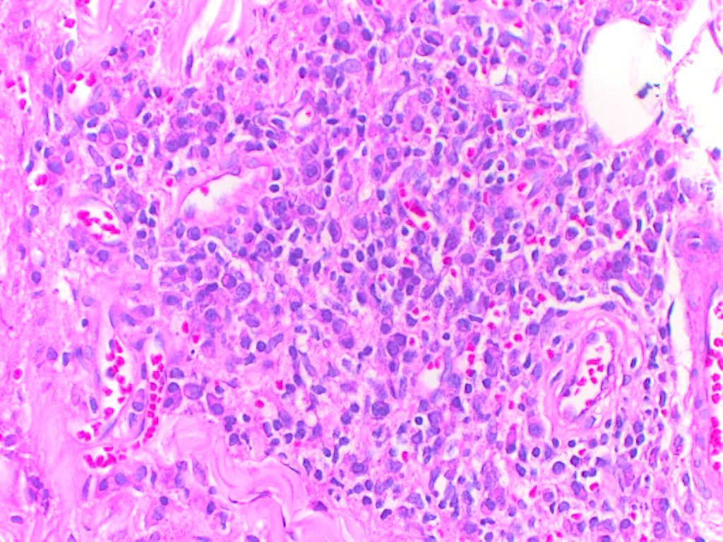 ivan_ircf71's tweet photo. Female,37 years, with lesions starting as macules that progress to nodules and ulcers, hyperpigmented and painful in the upper and lower extremities.
VDRL=positive https://t.co/82Cz7rqu1a
