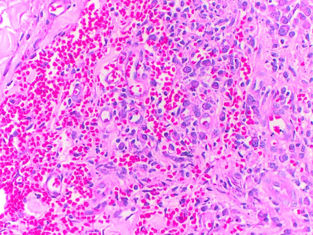 ivan_ircf71's tweet photo. Female,37 years, with lesions starting as macules that progress to nodules and ulcers, hyperpigmented and painful in the upper and lower extremities.
VDRL=positive https://t.co/82Cz7rqu1a