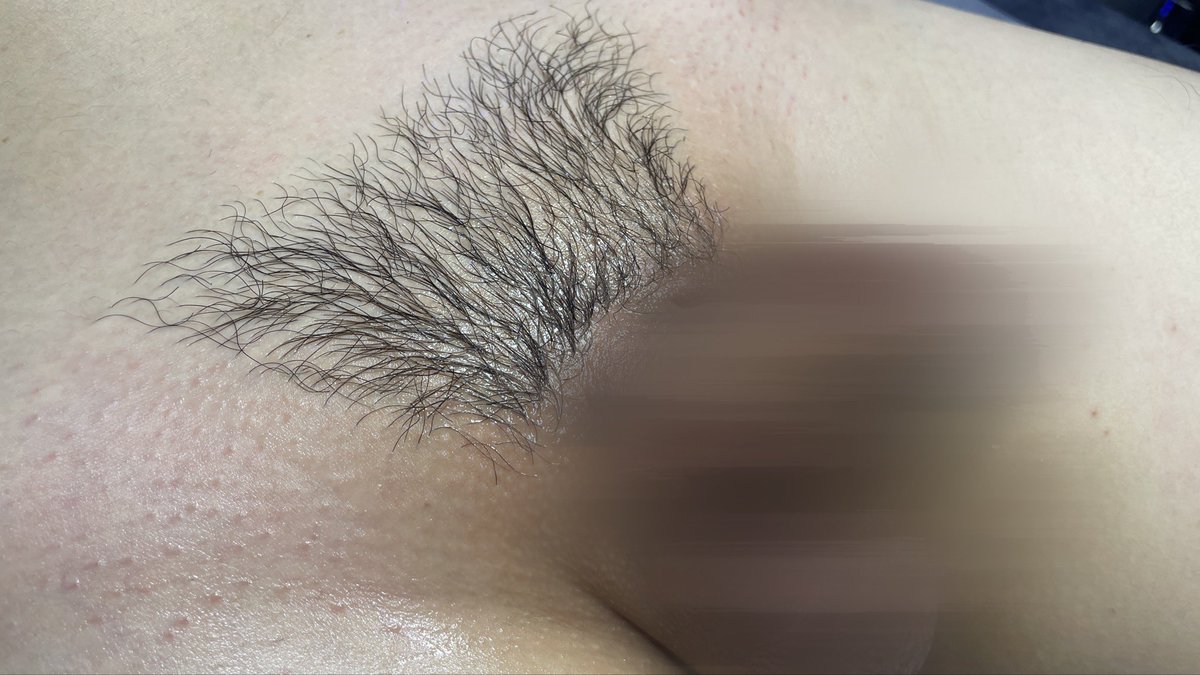 [하이가이즈 왁싱]

남자 브라질리언 왁싱 (중급)😀

수영장, 사우나, 헬스장 등에서
올누드가 부담스럽다면 디자인으로 
받아보세요!

남성전용 왁싱 네이버예약⬇️
naver.me/GKUxX6OD

 #남자왁서 #남자왁싱 #남성전문왁싱샵 #군자왁싱 #건대왁싱 #하이가이즈왁싱