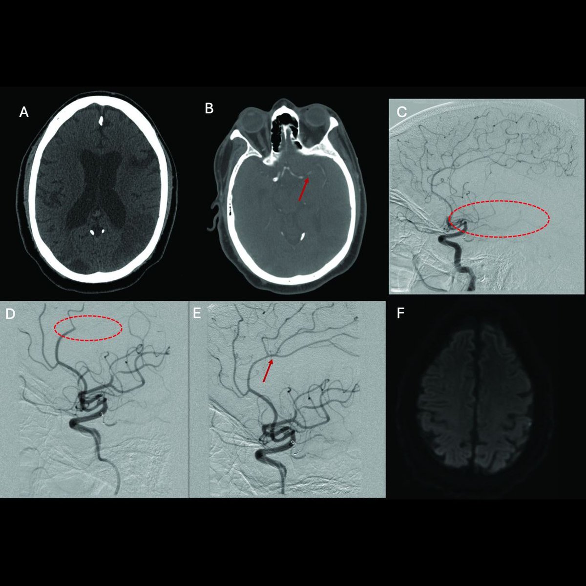 JNIS (@jnis_bmj) on Twitter photo Mechanical thrombectomy for DMVOs is gaining traction! In a multicenter study of 102 patients, the RED 43 catheter was found to be safe and effective for distal aspiration. bit.ly/4jNHWFE <a href="/Nickkhat/">Nicolas Khattar</a>
#Stroke #DMVO #Thrombectomy #EndovascularTherapy #NeuroIR Mechanical thrombectomy for DMVOs is gaining traction! In a multicenter study of 102 patients, the RED 43 catheter was found to be safe and effective for distal aspiration. bit.ly/4jNHWFE <a href="/Nickkhat/">Nicolas Khattar</a>
#Stroke #DMVO #Thrombectomy #EndovascularTherapy #NeuroIR