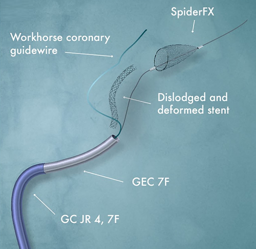 Giuseppe Biondi-Zoccai (@gbiondizoccai) on Twitter photo Did you know that you can retrieve an embolized stent using the SpiderFX embolic protection device? Now I do, thanks to an intriguing case by Atanasković et al just published in Catheterization and Cardiovascular Interventions onlinelibrary.wiley.com/doi/full/10.10… <a href="/ccijournal/">CCIjournal</a> Did you know that you can retrieve an embolized stent using the SpiderFX embolic protection device? Now I do, thanks to an intriguing case by Atanasković et al just published in Catheterization and Cardiovascular Interventions onlinelibrary.wiley.com/doi/full/10.10… <a href="/ccijournal/">CCIjournal</a>