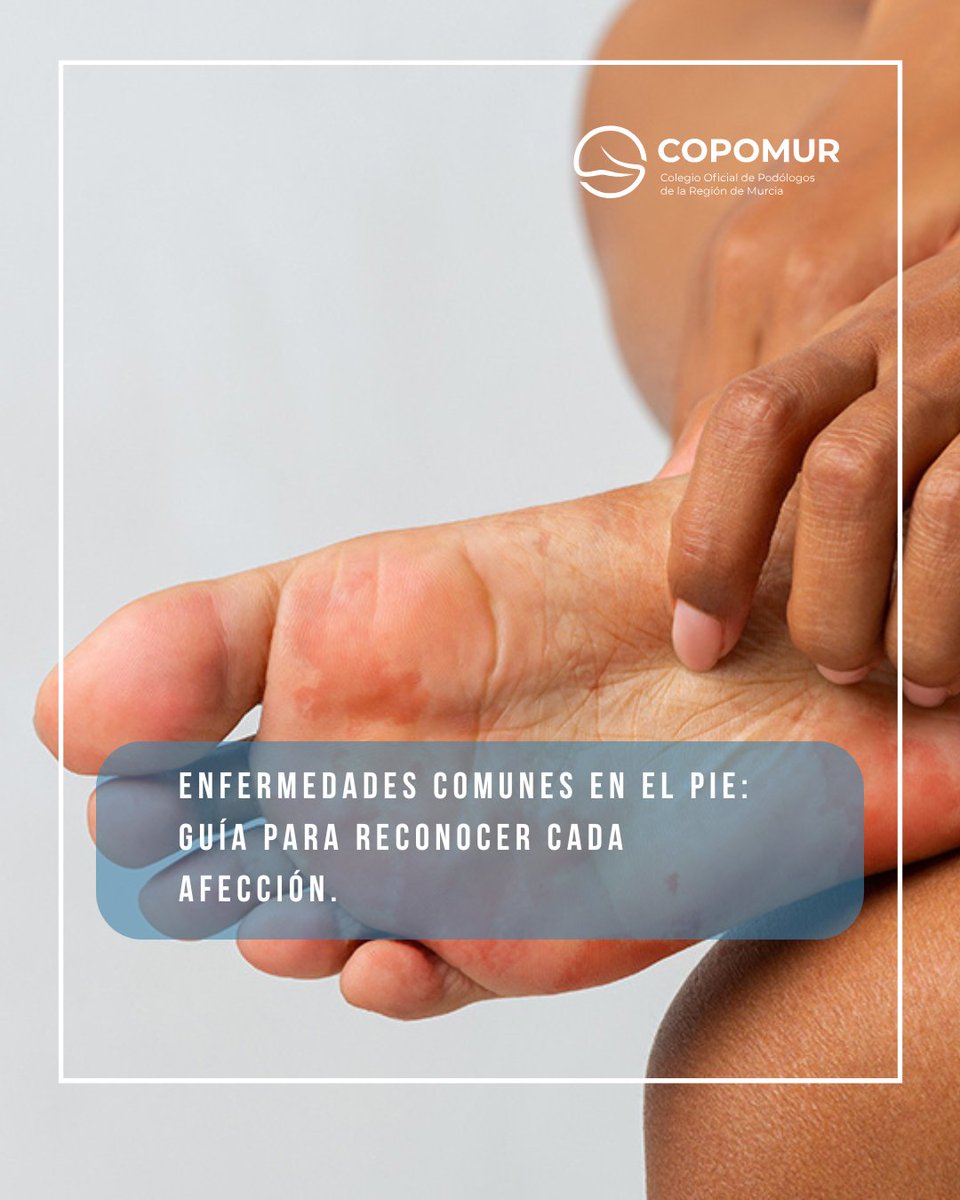 ¿Sabes cómo identificar las enfermedades más comunes del pie?
copomur.es/enfermedades-c…

#COPOMUR #SaludPodológica #CuidadoDeLosPies #EnfermedadesDelPie #Prevención