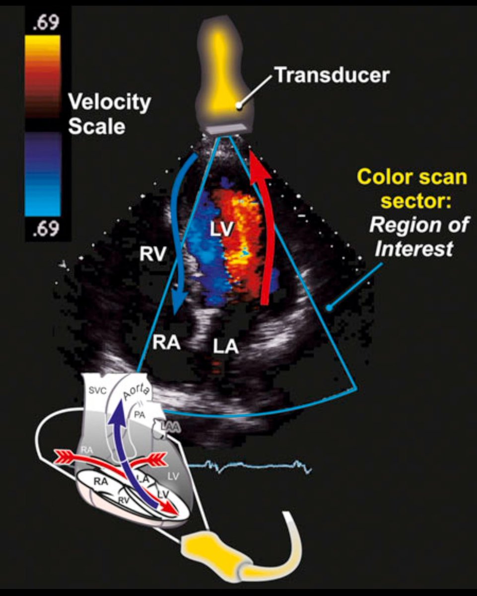 Color Flow Doppler in Echocardiography:
Color Doppler imaging displays blood flow direction and velocity within the heart. By convention:
🔴Red = Flow toward the transducer
🔵Blue = Flow away from the transducer
(BART rule: Blue Away, Red Toward)

The color velocity scale (shown