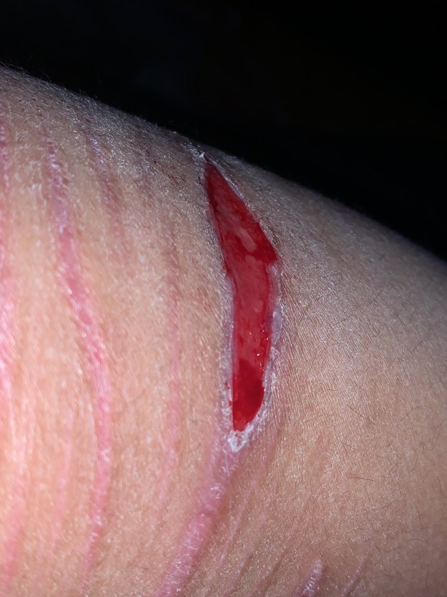 Vampiree_bite's tweet photo. idk why but its so satisfying picking scabs >_< https://t.co/MT8TonLS0i
