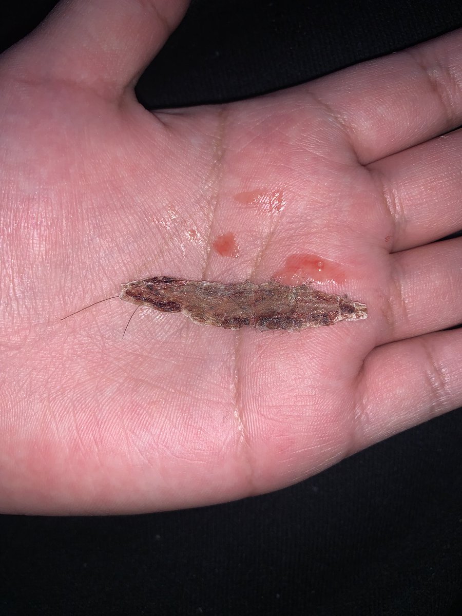 Vampiree_bite's tweet photo. idk why but its so satisfying picking scabs >_< https://t.co/MT8TonLS0i