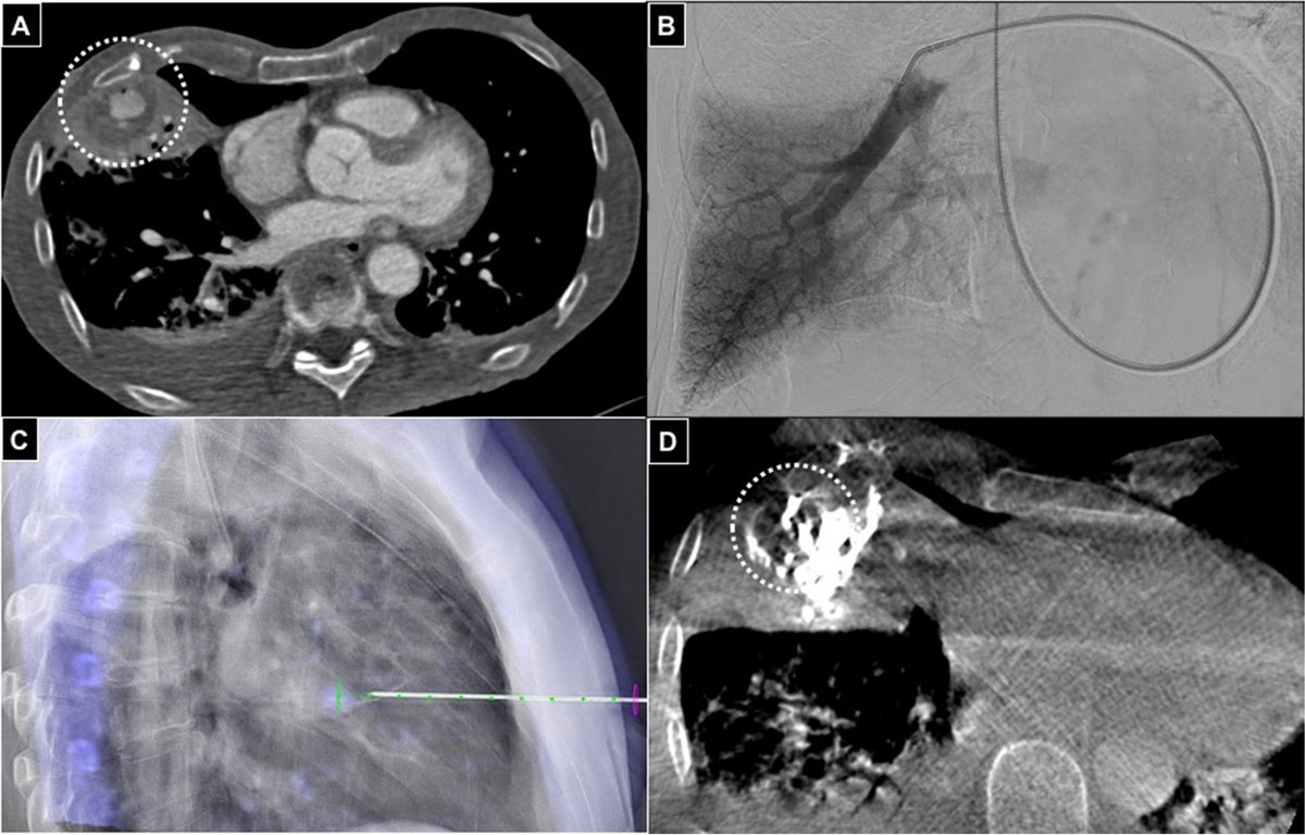 #sundayread

This paper explores pseudoaneurysms embolization with glue via percutaneous direct puncture: a multicenter experience on 54 patients

cvirendovasc.springeropen.com/articles/10.11…

#irad #interventionalradiology