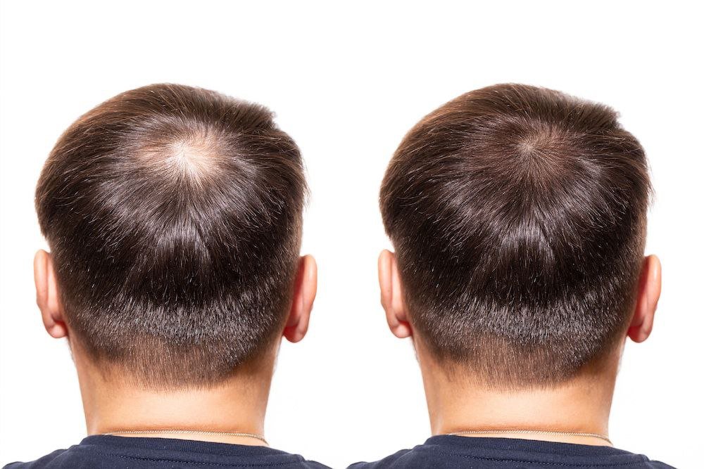 Your thinning hair due to "aging" – it's actually a NUTRIENT DEFICIENCY, and guess what? It's totally fixable.

The $13.9 billion hair care industry pushes shampoos, but the real answer is right on your plate.

Here’s the inside scoop that they’d rather keep quiet: 🧵