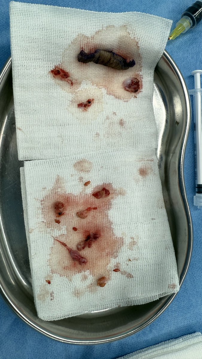 PlastiqueGEMIA's tweet photo. 这位男士2月26日在上海一家医院完成了阴茎延长增粗术，样后出现龟头和内板的顽固性水肿，术前诊断为瘢痕增生伴皮肤狭窄环形成。手术中我们松解了狭窄环去除了包皮下的瘢痕组织，恢复了阴茎的正常外形。This gentleman underwent penile lengthening and girth augmentation surgery at a hospital in Shanghai on February 26. Postoperatively, he developed persistent edema of the glans and inner foreskin. The preoperative diagnosis was scar hyperplasia with skin stricture ring formation. During the surgery, we released the stricture ring, removed the scar tissue under the foreskin, and restored the normal appearance of the penis.
