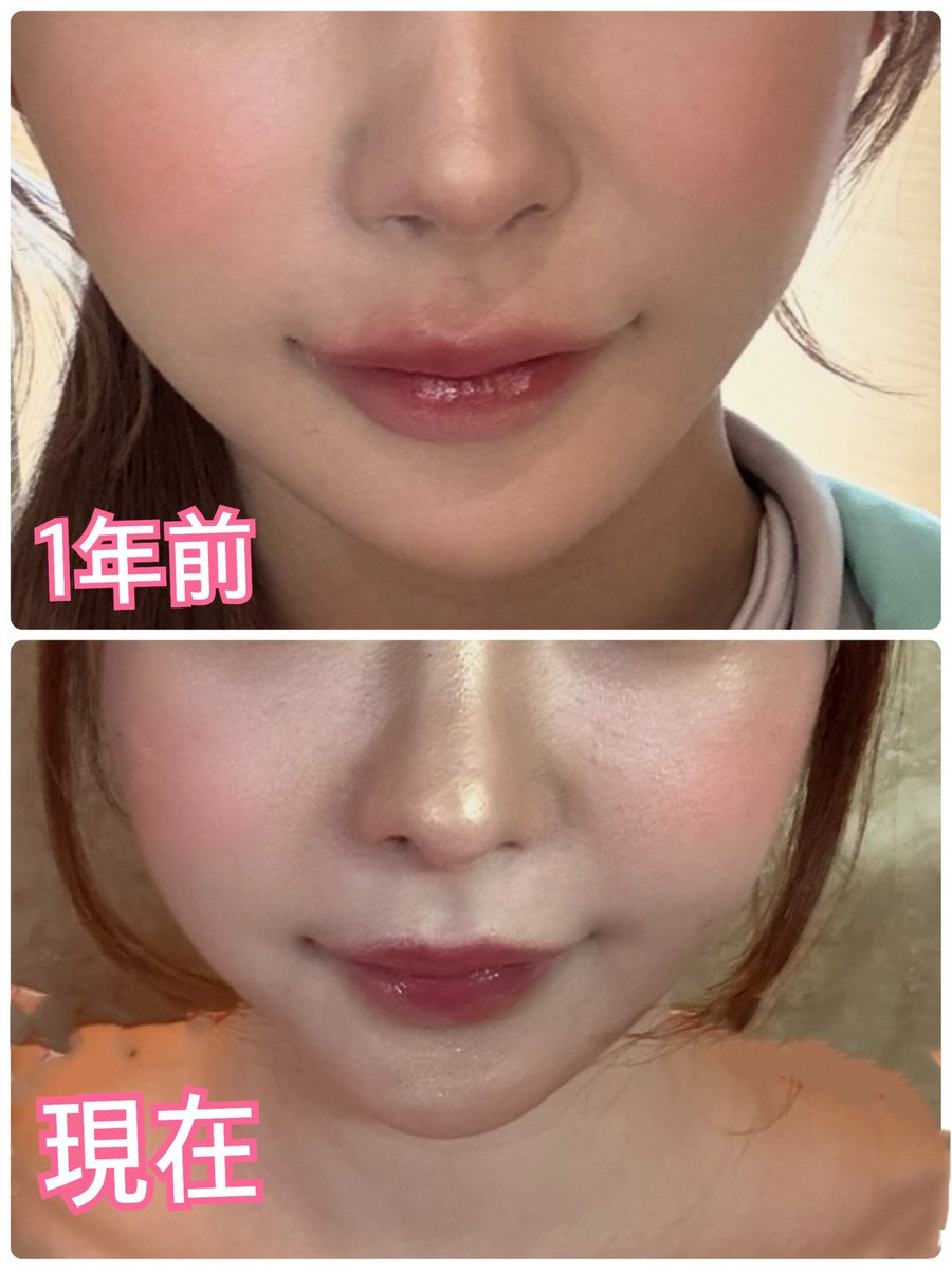 鬱病になってから一気にフェイスラインや肌が老け込んだので、ストレスは老化に物凄い影響があることがわかる。

なんなら人中も伸びた気がする。

吹き出物もほとんど出来たことなかったのに肌荒れも凄くするようになって毛穴も目立つようになった。

ここから、元の顔に戻せるようにレポしていきます