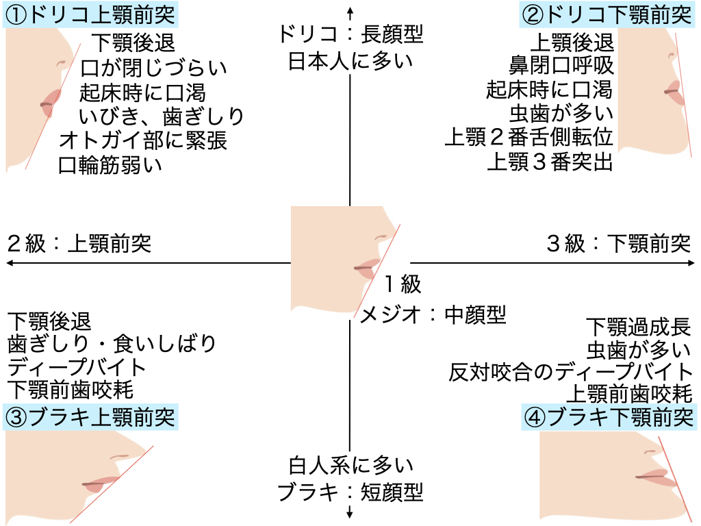 人の顔は4つに分類できます。 それぞれ歯列咬合が違っていて問題点も