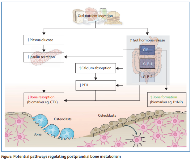 The rising prevalence of people with a high #BMI, increasing rates of type 2 #diabetes, and a greater fall risk in people with #obesity and type 2 diabetes has contributed to a substantial rise in #fractures thelancet.com/journals/landi…   
#T2D #osteoporosis #BoneHealth