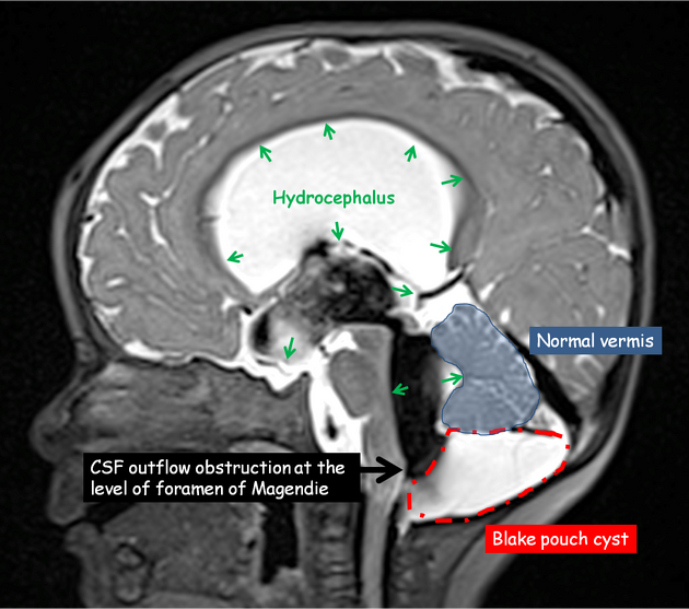 DocNavarrow's tweet photo. 💡🧠Blake’s pouch cyst causes obstructive hydrocephalus with dilatation of the fourth, third, and lateral ventricles, due to failed opening of the foramen of Magendie.

🫂Case courtesy of Bouhouche Abdeldjalil, from the case https://t.co/GpDD5XS1i2 https://t.co/VoK1YzSrr5