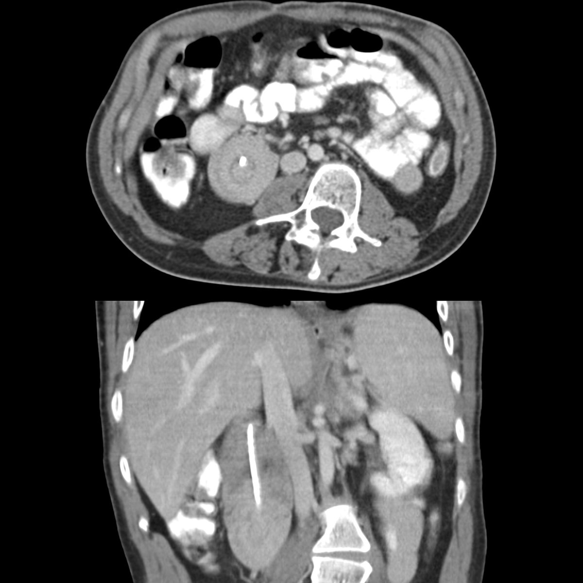 pedsimaging's tweet photo. #FOAMed #MedEd #FOAMPed #FOAMRad #PedsRad #RadEd #RadRes #radiology #pediatrics #PedSurgery #PedSurg #SoMe4PedSurg #radiología #radiologie

Young adult with a gastrojejunostomy tube and chronic abdominal pain

Axial (above) CT with contrast of the abdomen shows a round soft tissue mass to the right of the vertebral body that has a target sign appearance and that has a jejunostomy tube coursing in the center of it. Coronal CT (below) shows the soft tissue mass to be long in length and to comprise the second and third parts of the duodenum and the proximal jejunum and to have the jejunostomy tube coursing throughout its length.

The diagnosis was gastrojejunostomy tube malfunction due to the formation of a duodenal-jejunal intussuception forming around the tip of the jejunostomy tube.

Learn more: https://t.co/XpThmfLBex