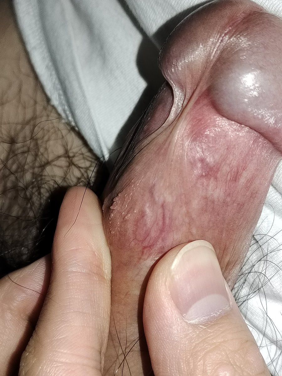 renda_crb's tweet photo. 你们觉得这个赘生物是什么？#hpv #尖锐湿疣？ https://t.co/07qEtKCcal