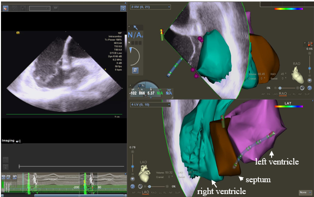 Journal of Invasive Cardiology (@invasivecardiol) on Twitter photo April Clinical Image: A Precise Endomyocardial Biopsy Method Guided by the Electroanatomical Mapping System ➡️ hubs.ly/Q03jVPBB0
<a href="/DLBHATTMD/">Dr. Deepak L. Bhatt</a> #cardioTwitter #cardioX #cardiology #interventionalcardiology April Clinical Image: A Precise Endomyocardial Biopsy Method Guided by the Electroanatomical Mapping System ➡️ hubs.ly/Q03jVPBB0
<a href="/DLBHATTMD/">Dr. Deepak L. Bhatt</a> #cardioTwitter #cardioX #cardiology #interventionalcardiology