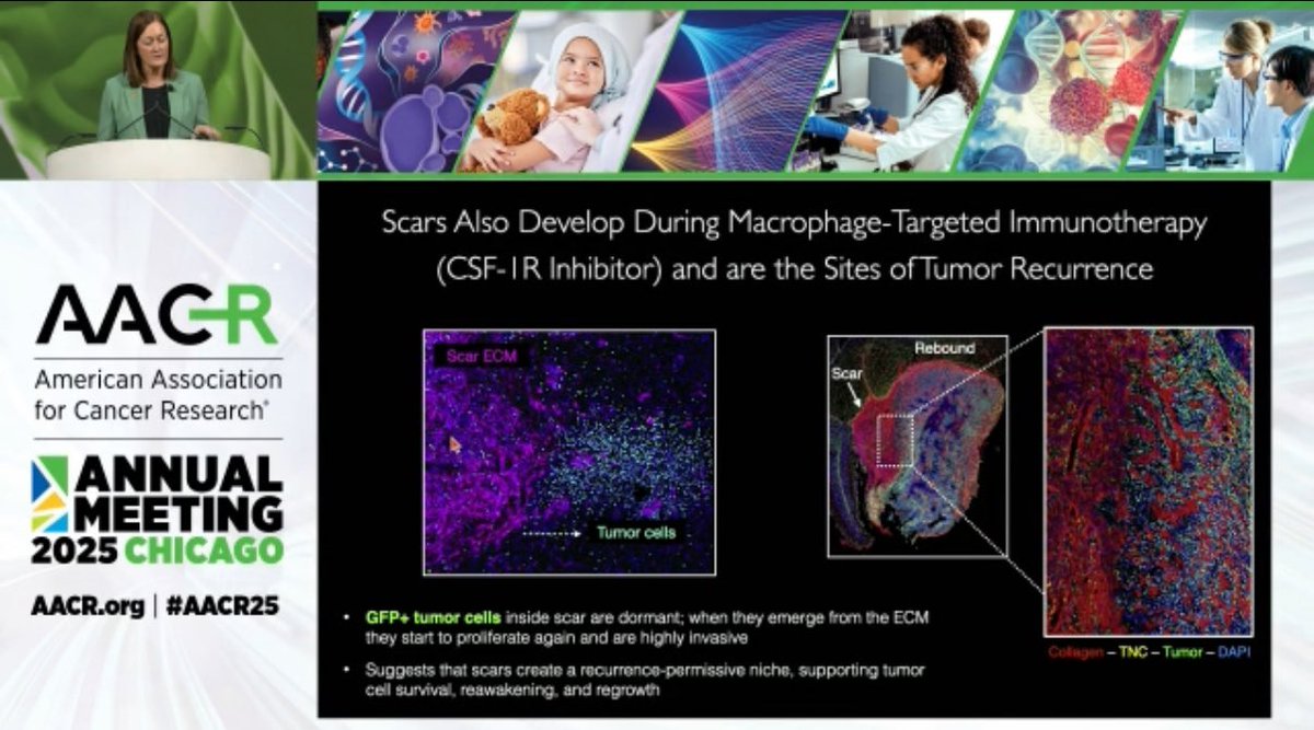 Jennifer Buell (@jbuell01) on Twitter photo Great Pres by <a href="/JohannaJoyce_/">Johanna Joyce</a> #AACR25 Prior cancer tx leave fibrotic scars — immune safehouses where dormant tumor cells hide and exhaustion reigns. PV macrophages responding to TGFβ drive. Potential for #INKTs #AGENT797 to break the cycle and reignite immune attack. <a href="/MiNK_iNKT/">MiNK Therapeutics</a> Great Pres by <a href="/JohannaJoyce_/">Johanna Joyce</a> #AACR25 Prior cancer tx leave fibrotic scars — immune safehouses where dormant tumor cells hide and exhaustion reigns. PV macrophages responding to TGFβ drive. Potential for #INKTs #AGENT797 to break the cycle and reignite immune attack. <a href="/MiNK_iNKT/">MiNK Therapeutics</a>