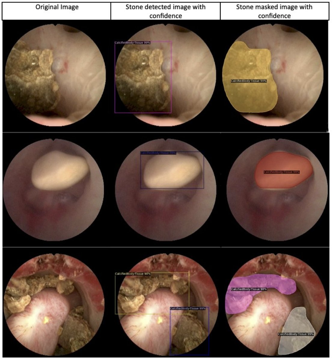 UroToday.com (@urotoday) on Twitter photo Development and Evaluation of a machine learning-based approach for real-time #KidneyStone detection and segmentation in robotic flexible ureterorenoscopy. Presented by <a href="/tzevattefik/">Tzevat TEFIK</a> <a href="/itfuroloji/">İ.Ü. İ.T.F. Üroloji</a>. #AUA25 written coverage by <a href="/mariahch00/">Mariah</a> <a href="/UCI_Urology/">UCI Urology</a> > bit.ly/4jD9A8D Development and Evaluation of a machine learning-based approach for real-time #KidneyStone detection and segmentation in robotic flexible ureterorenoscopy. Presented by <a href="/tzevattefik/">Tzevat TEFIK</a> <a href="/itfuroloji/">İ.Ü. İ.T.F. Üroloji</a>. #AUA25 written coverage by <a href="/mariahch00/">Mariah</a> <a href="/UCI_Urology/">UCI Urology</a> > bit.ly/4jD9A8D