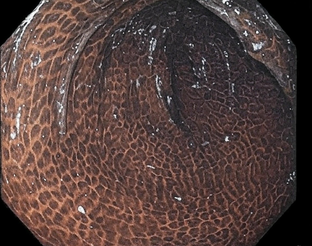 Leopard skin appearance during colonoscopy. What’s the diagnosis?