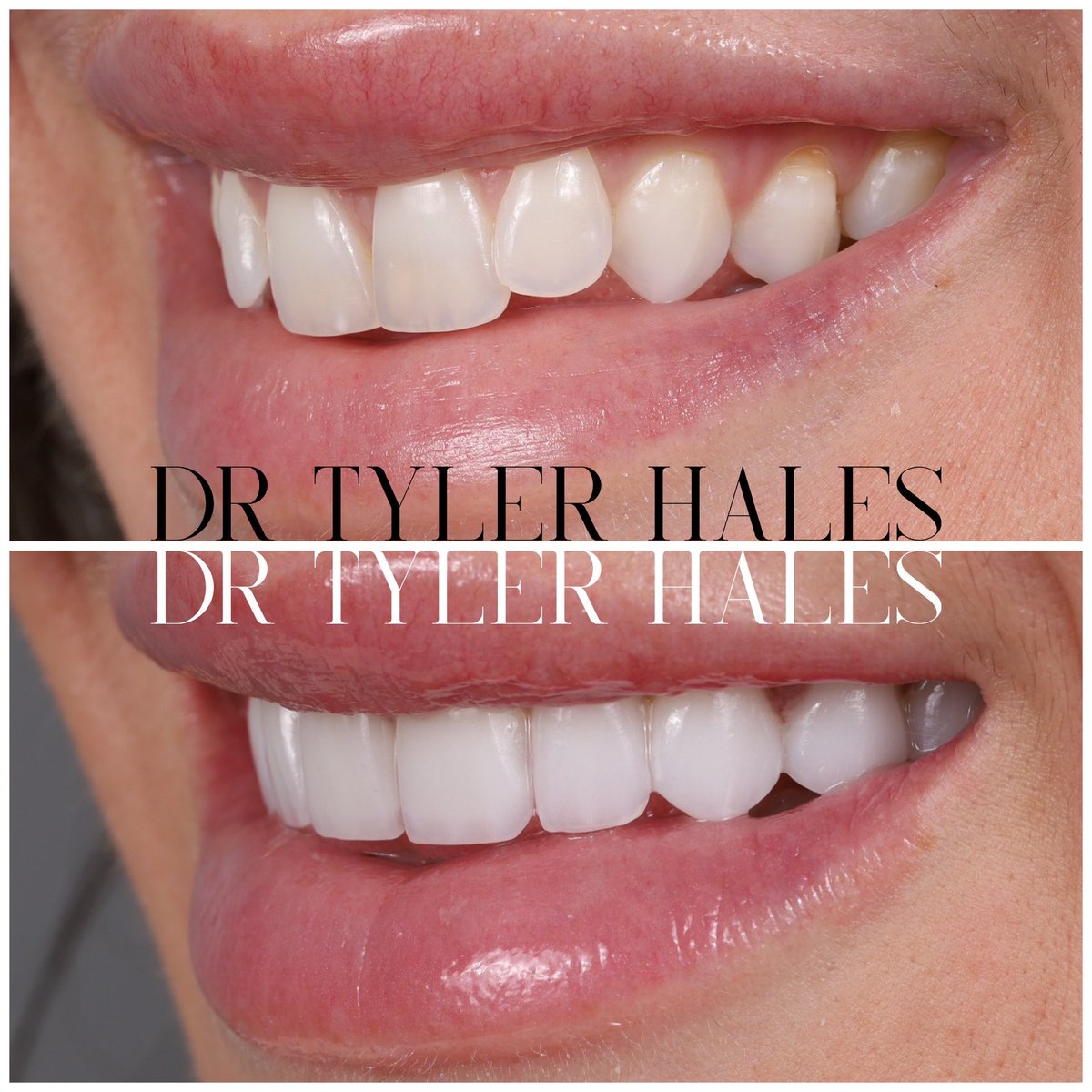 Crooked teeth, recession, and a narrow smile were all things this patient wanted to change about her smile. She had felt self conscious about her smile for so long and was now ready to do something about it. In a case like this, it’s important to understand what is happening.