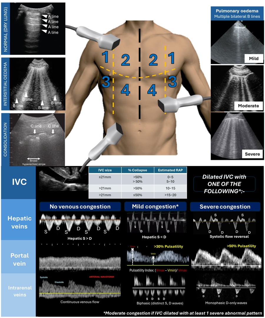 A Pragmatic Approach to Acute Cardiorenal Syndrome: Diagnostic Strategies and Targeted Therapies to Overcome Diuretic Resistance

CCR Journal Watch - tracking the critical care literature daily
criticalcarereviews.com/latest-evidenc…