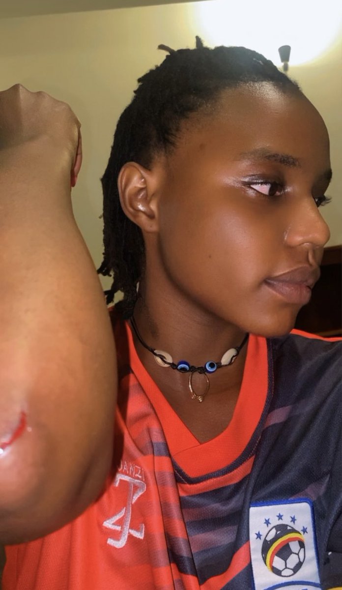 MulungiKhloe's tweet image. I fell down and fractured my right elbow!