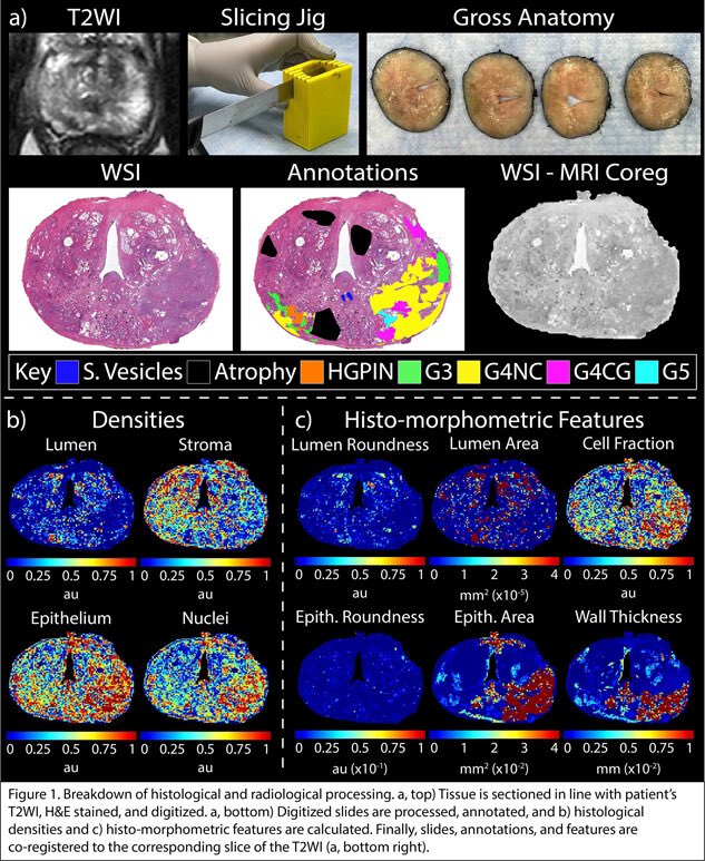 Zeyad Schwen MD (@zschwen) on Twitter photo Come see the awesome Prostate Cancer session lined up 🔥🔥
3:30-5:30 Casanova 503
🚨 Spoiler Alert 🚨
➡️ AI detection
➡️ cognitive vs software
➡️ genomic testing
And a whole bunch of other stuff !
<a href="/CleClinicUro/">Cleveland Clinic Urology</a> #AUA25 #AUA2025 Come see the awesome Prostate Cancer session lined up 🔥🔥
3:30-5:30 Casanova 503
🚨 Spoiler Alert 🚨
➡️ AI detection
➡️ cognitive vs software
➡️ genomic testing
And a whole bunch of other stuff !
<a href="/CleClinicUro/">Cleveland Clinic Urology</a> #AUA25 #AUA2025