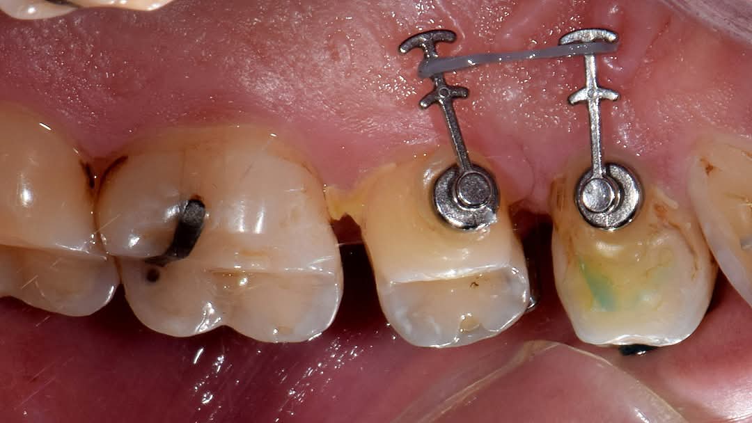 OviDentalGo's tweet image. 🚫 Adhesive Power Arms! Excellent for the palatal surface and to prevent rotations (due to lack of palatal traction) and tilting (due to low palatal traction with buttons).

#orthodontics #brackets #aparelhooortodontico  #dentist #dentistry #ovidental