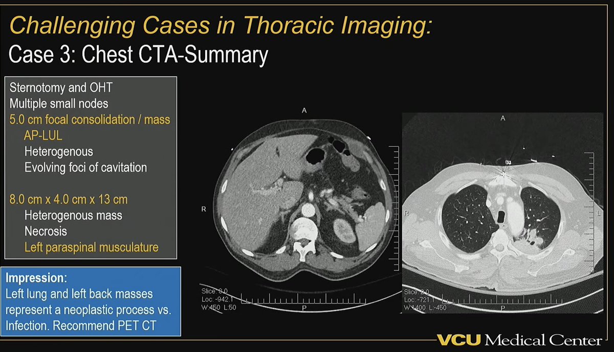 LaurenGroner's tweet photo. Interesting and engaging session of challenging cases in thoracic imaging with a super⭐️ panel of #chestrads at #ARRS25
My pick for most interesting case: 48 yo 🚹 with disseminated Nocardiosis 3 months s/p orthotopic heart transplant 🫀🫁🧠 https://t.co/xr0wWIs0Np