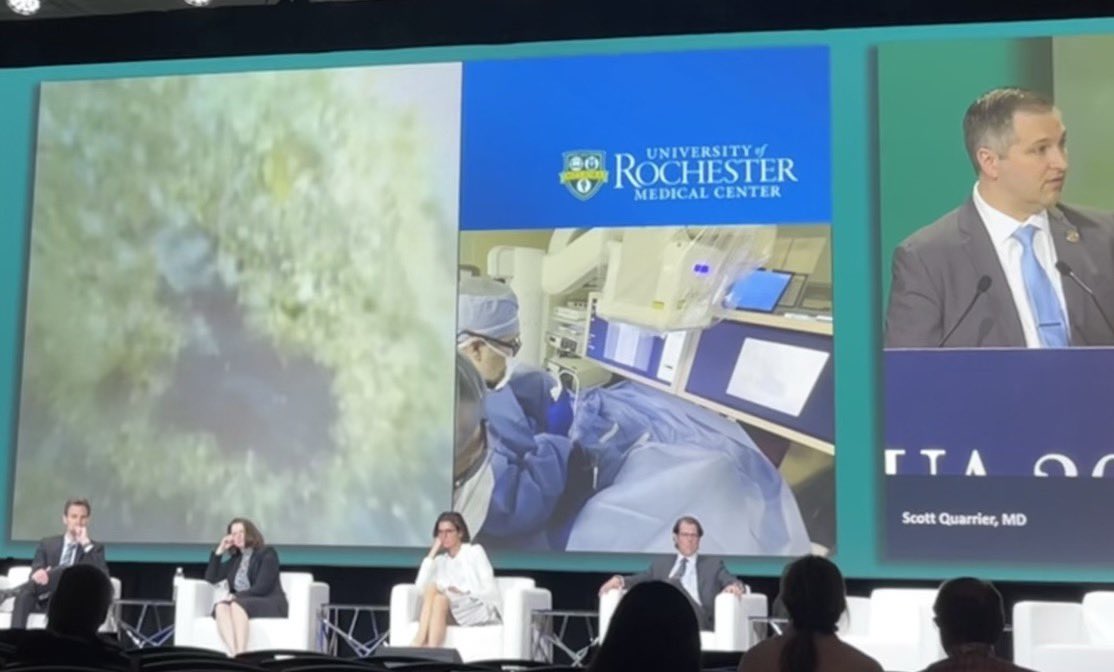 David Volm (@dvolm) on Twitter photo Fantastic Semi-Live Ureteroscopy by <a href="/squarrier/">Scott Quarrier MD MPH</a> where he discussed the value of versatile equipment. Ability for #Magneto to both Bust & Dust this impacted stone was key. Cook Ascend U-scope to access & visualize. ✅ <a href="/CookMedSurg/">Cook Medical--MedSurg Division</a> #AUA25 #AUA2025 Fantastic Semi-Live Ureteroscopy by <a href="/squarrier/">Scott Quarrier MD MPH</a> where he discussed the value of versatile equipment. Ability for #Magneto to both Bust & Dust this impacted stone was key. Cook Ascend U-scope to access & visualize. ✅ <a href="/CookMedSurg/">Cook Medical--MedSurg Division</a> #AUA25 #AUA2025