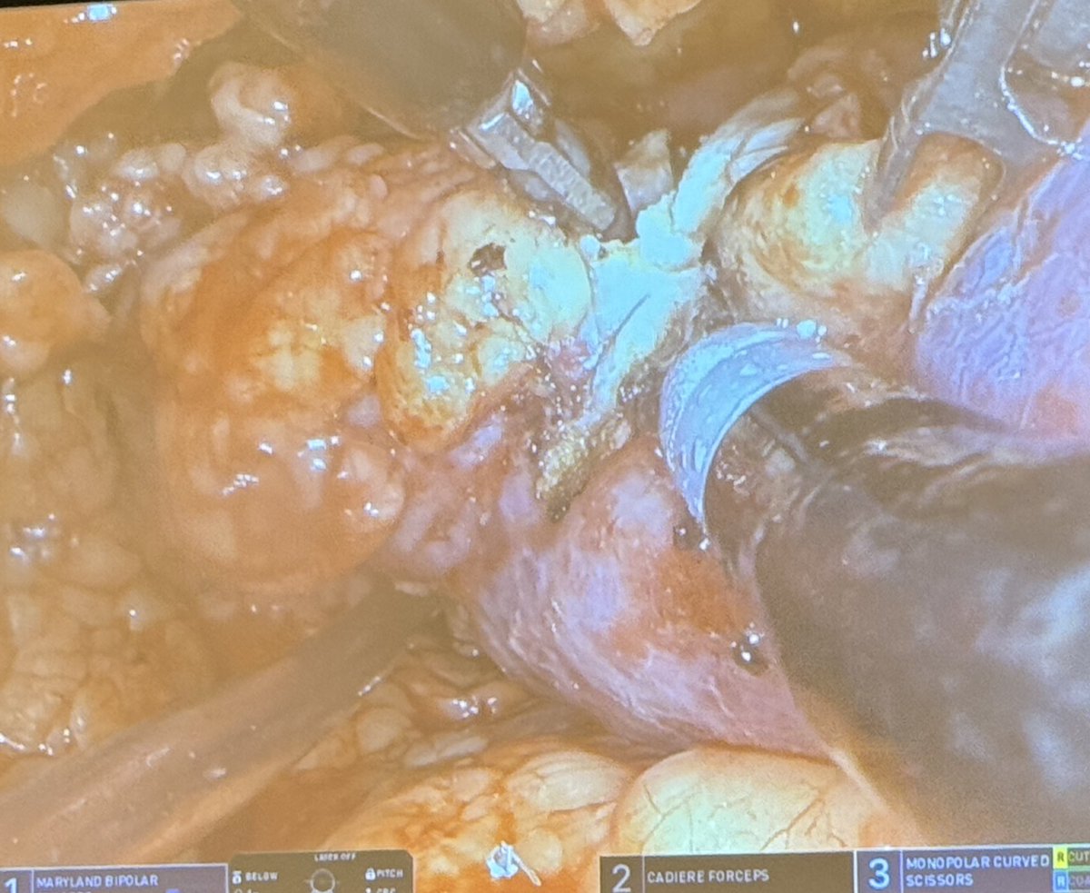 GU Oncology Now (@guoncologynow) on Twitter photo #AUA25 takeaway: <a href="/RoboticsUrology/">Mutahar Ahmed</a> <a href="/HUMCUrology/">HackensackUMC Department of Urology</a> presenting on single port lower anterior access for upper pole partial nephrectomy - maintaining strong 4th arm traction makes a big difference during tumor excision. #AUA25 takeaway: <a href="/RoboticsUrology/">Mutahar Ahmed</a> <a href="/HUMCUrology/">HackensackUMC Department of Urology</a> presenting on single port lower anterior access for upper pole partial nephrectomy - maintaining strong 4th arm traction makes a big difference during tumor excision.