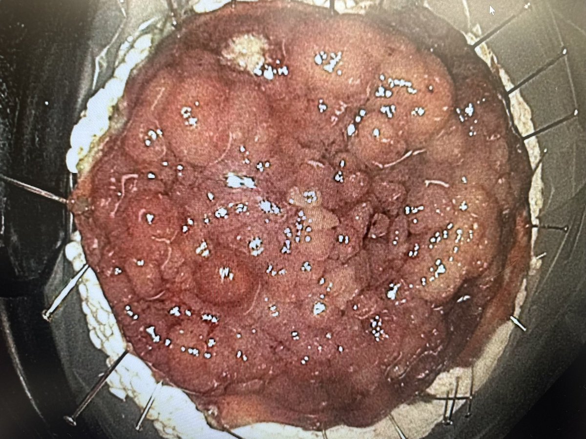 Fares Ayoub (@faresayoubmd) on Twitter photo Hear me out: this R0 resection of an 8 cm ascending colon LST wasn’t easy. But I did it, and, with the right tools, skills & mentors (<a href="/EndoscopyOthman/">Mohamed Othman</a>): you can too. This course ⬇️ is where my ESD journey started. Join us! ESD in the US is not only possible, but truly exciting. Hear me out: this R0 resection of an 8 cm ascending colon LST wasn’t easy. But I did it, and, with the right tools, skills & mentors (<a href="/EndoscopyOthman/">Mohamed Othman</a>): you can too. This course ⬇️ is where my ESD journey started. Join us! ESD in the US is not only possible, but truly exciting.