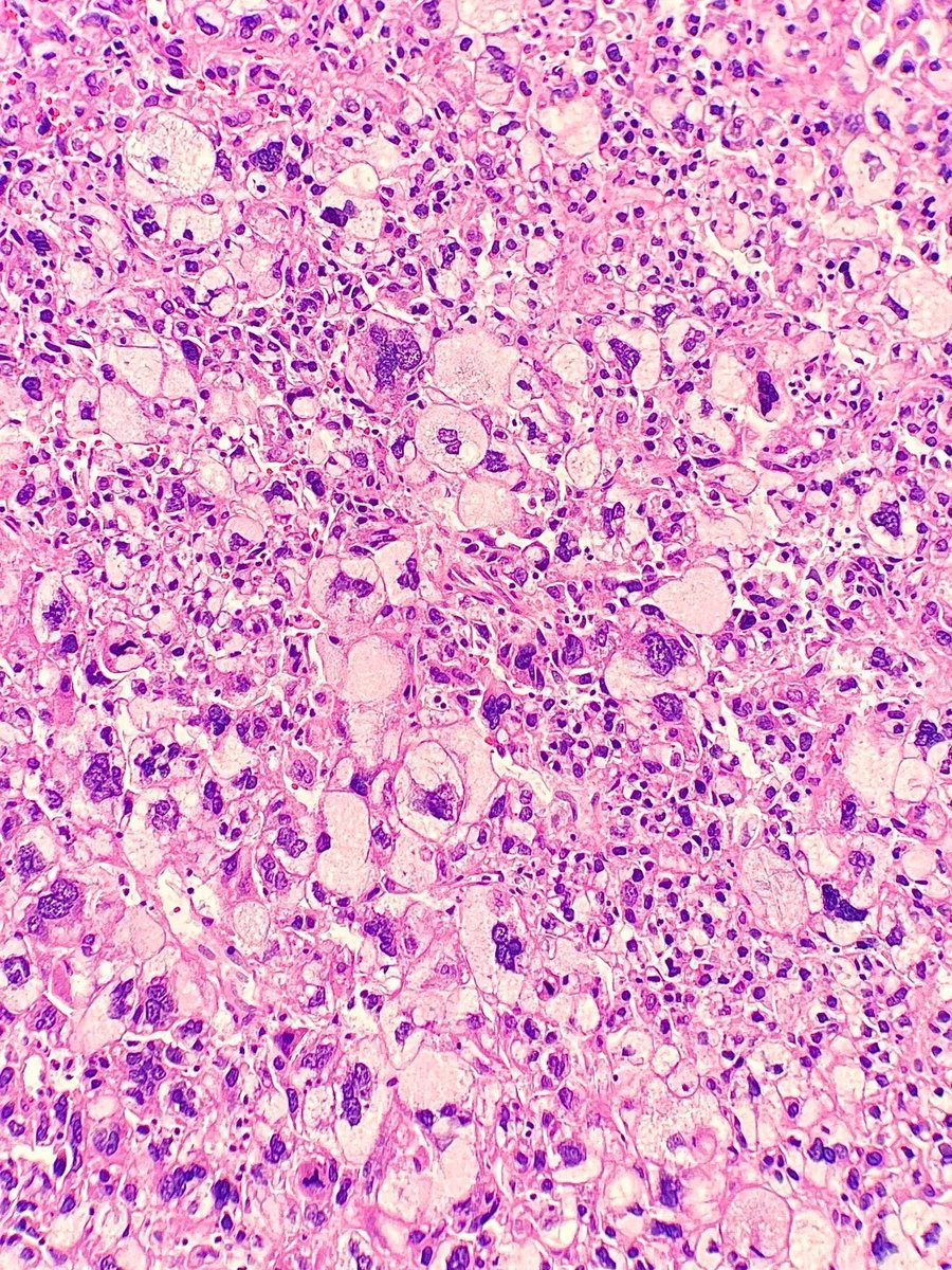 Liver resection specimen revealing a tumor multinucleated giant cells, pleomorphic tumor cells, and extensive clear cell change. What is the diagnosis? Answer: buff.ly/4dluY61 #PathTwitter #PathArt #MedTwitter