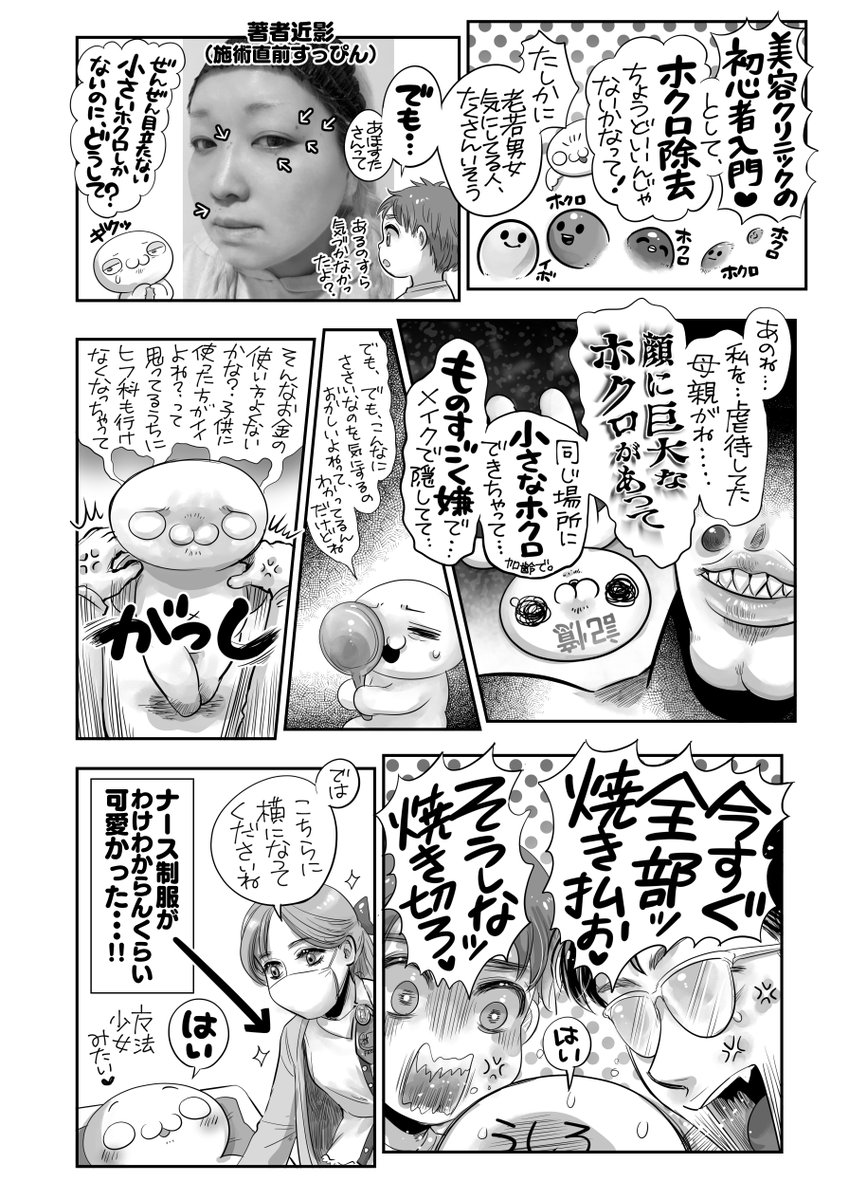 「そんな小さいホクロ、気にしなくてもよくない❓」
過去の虐待に関わる根深い記憶で、すごく嫌だった(似てきたのかも?という恐怖)けど、誰にも言えず😔他人のカメラで撮られるのが実は嫌だった。ホクロ写っちゃうから・・・
→それが今はこう‼️‼️‼️(3枚目写真🚬)
嫌な記憶ごと焼き消した‼️✌️☺️ 