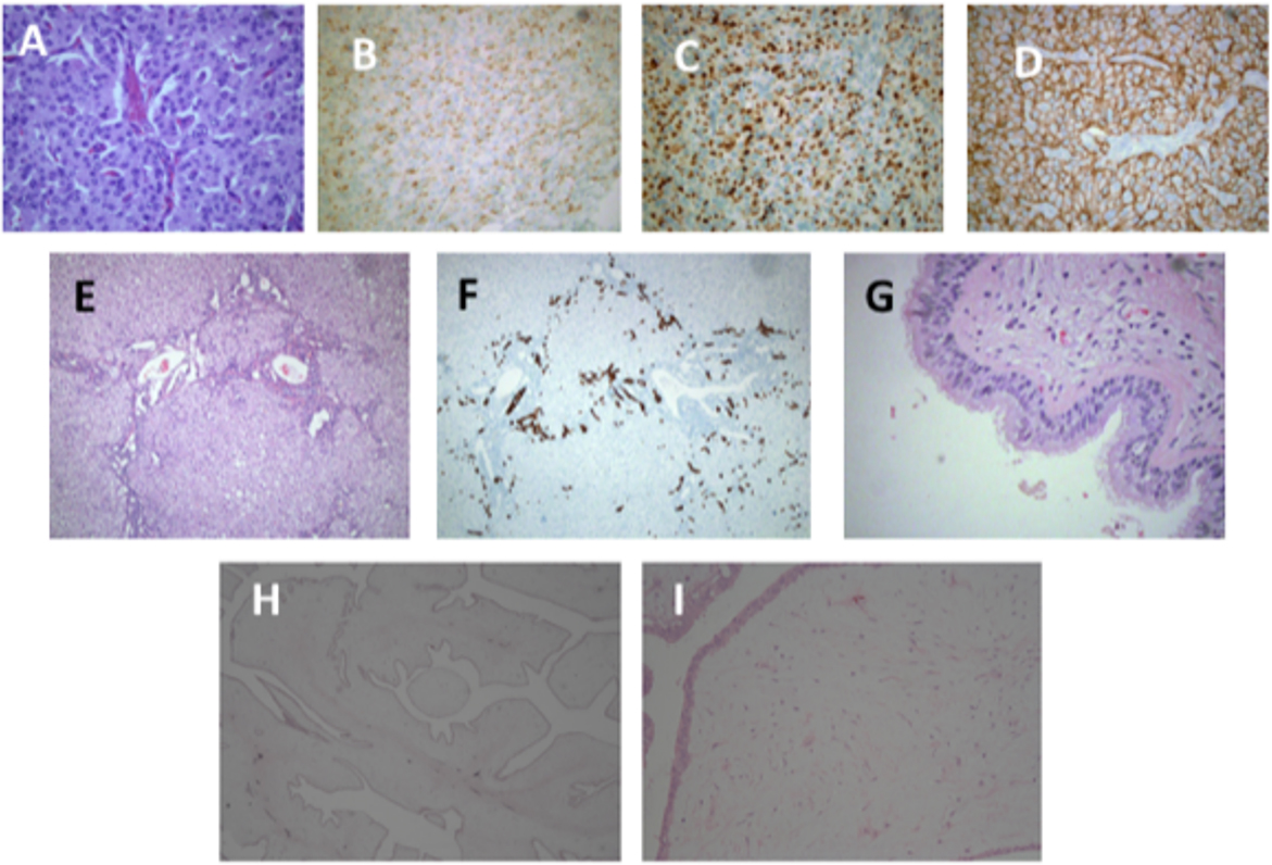 🎉Article Alert: Kabuki syndrome and rare tumors in a young girl carrying a frameshift KMT2D mutation
#Kabukisyndrome 

👉 Kabuki syndrome (KS) is a genetic disorder characterized by typical facial dimorphisms.       

👏Read more: 
f.oaes.cc/xmlpdf/55a237d…