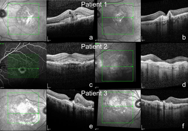 Graefes rdcu.be/edSSk 
HRM patterns-prognostic value in predicting VA during long-term VEGF treatment. 
<a href="/ClinMedJournals/">Springer Medicine</a> <a href="/Ophthalmologen/">DOG-Augenheilkunde</a> <a href="/meyer_professor/">Carsten H. Meyer</a> <a href="/oliverzeitz/">Oliver Zeitz</a> <a href="/AndrzejGrzybow/">Andrzej Grzybowski</a> <a href="/EdmundTsuiMD/">Edmund Tsui, MD</a> @kopicAndrijana <a href="/JiaHorungMD/">Jia-Horung Hung</a> <a href="/KusuharaSentaro/">Sentaro Kusuhara</a> <a href="/SN_Ophthalmol/">Springer Nature Ophthalmology</a>