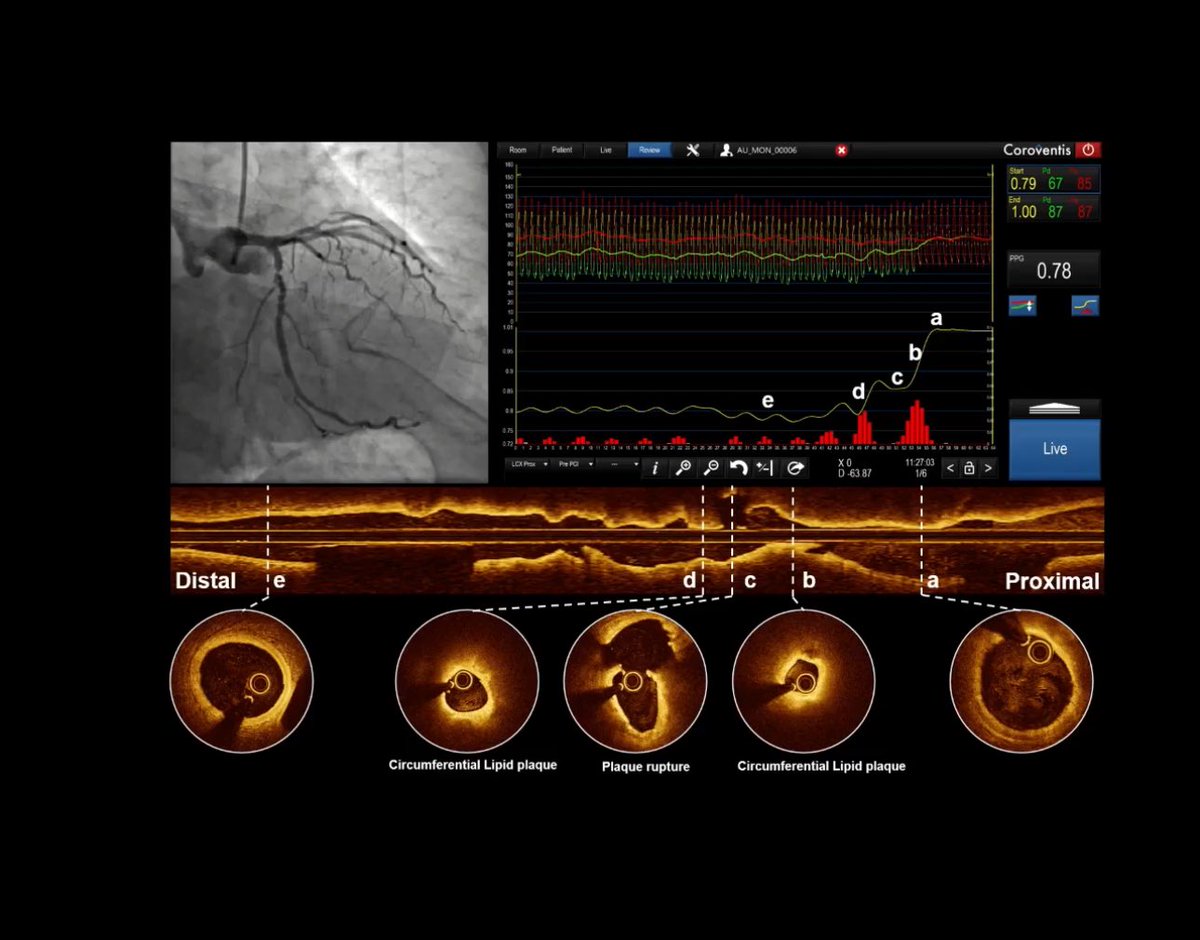 ⁦<a href="/ColletCarlos/">Carlos Collet MD PhD</a>⁩ and the ⁦<a href="/OptimaCTO/">Optima Education</a>⁩ course live now.. a dont miss educational event