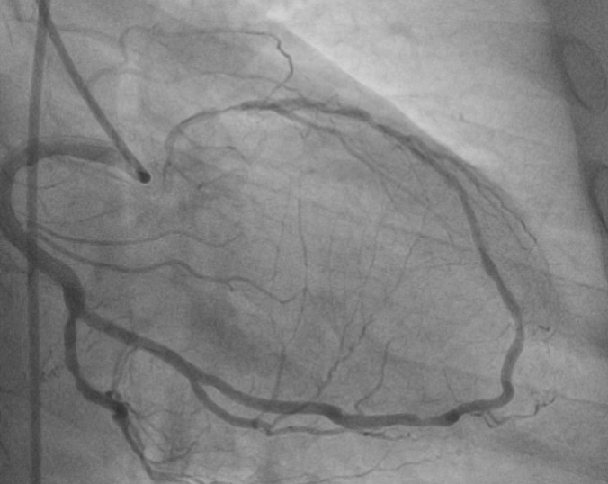 What can you perceive except for a human 🫀?

An image is worth a 1,000 words - what does this one depict ? Participate in quiz here🔗pcronline.com/Cases-resource…

🖼️submitted by Eirini Dri, Sofia Vaina, Anastasios Milkas, Konstantinos Tsioufis from 🇬🇷 and selected for #EuroPCR