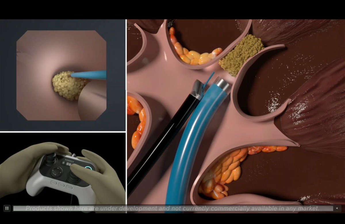 Steffi Yuen (@steffiyuen) on Twitter photo !!!enjoyed live streaming plenary #endourology #AUA2025 by <a href="/DrBenChew/">Dr. Ben Chew</a>
It’s all about #suction! #FANS #DISS #CVAC #Monarch
📰🗞️🔗 auanews.net/issues/article…
<a href="/PusenMedical/">Pusen Medical</a> <a href="/CalyxoInc/">Calyxo, Inc.</a> #fanofFANS #RoboticRIRS #UroSoMe !!!enjoyed live streaming plenary #endourology #AUA2025 by <a href="/DrBenChew/">Dr. Ben Chew</a>
It’s all about #suction! #FANS #DISS #CVAC #Monarch
📰🗞️🔗 auanews.net/issues/article…
<a href="/PusenMedical/">Pusen Medical</a> <a href="/CalyxoInc/">Calyxo, Inc.</a> #fanofFANS #RoboticRIRS #UroSoMe
