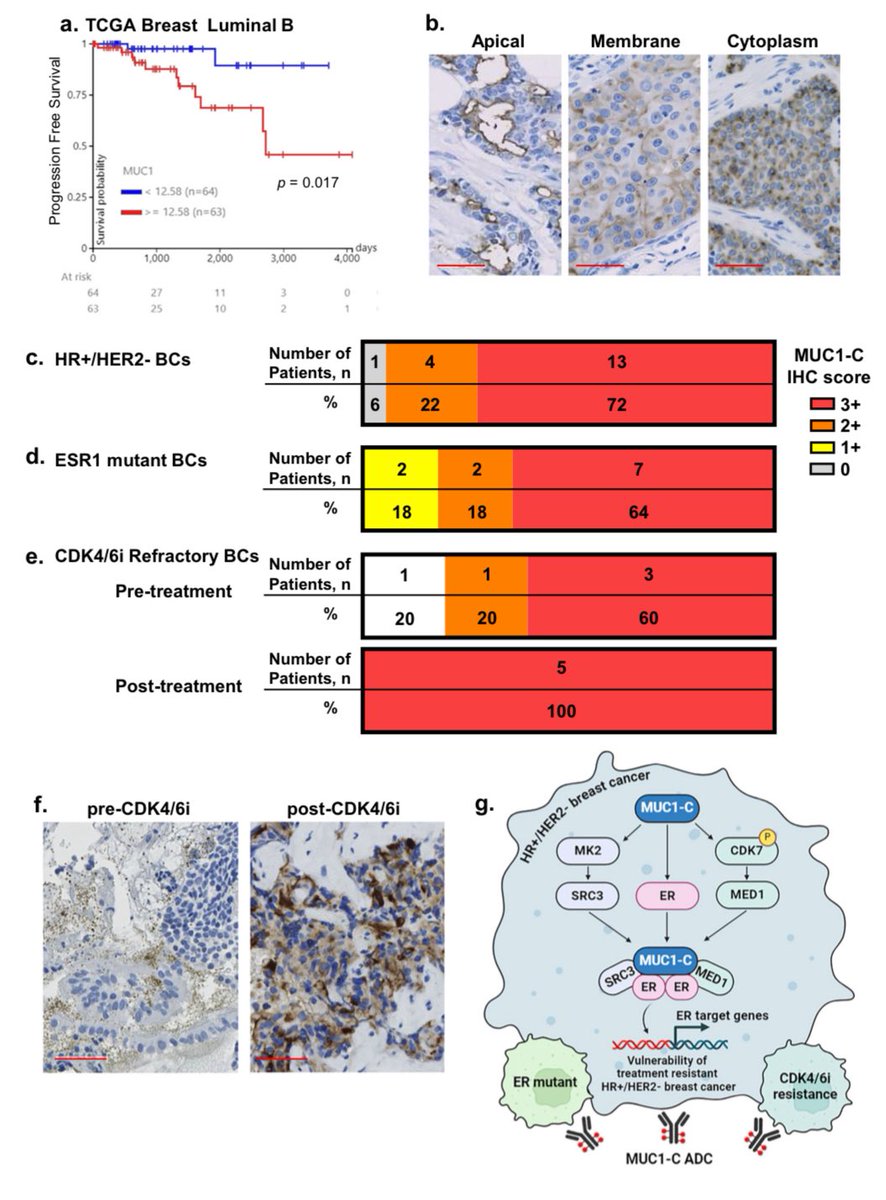 Goutham Sunny (@medoncodoc) on Twitter photo MUC1-C is a potential target for all HR+ Her2 neg drug resistant tumors. Future ADC target loading!! 😉
<a href="/tuttsakhil/">Dr Akhil Santhosh</a> <a href="/stolaney1/">Sara Tolaney</a> <a href="/hoperugo/">Hope Rugo</a> <a href="/matteolambe/">Matteo Lambertini, MD PhD</a> <a href="/jtgeorgy/">Josh Thomas Georgy</a> <a href="/brunolarvol/">ONCO BRUNO</a>
#bcsm
doi.org/10.1038/s41523… MUC1-C is a potential target for all HR+ Her2 neg drug resistant tumors. Future ADC target loading!! 😉
<a href="/tuttsakhil/">Dr Akhil Santhosh</a> <a href="/stolaney1/">Sara Tolaney</a> <a href="/hoperugo/">Hope Rugo</a> <a href="/matteolambe/">Matteo Lambertini, MD PhD</a> <a href="/jtgeorgy/">Josh Thomas Georgy</a> <a href="/brunolarvol/">ONCO BRUNO</a>
#bcsm
doi.org/10.1038/s41523…
