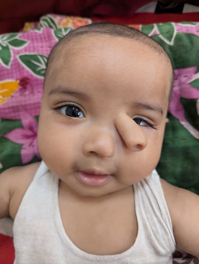 A supernumerary nostril is a rare congenital condition where an individual is born with an extra nostril.